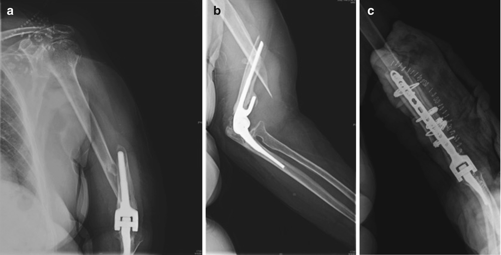 Elbow Replacement