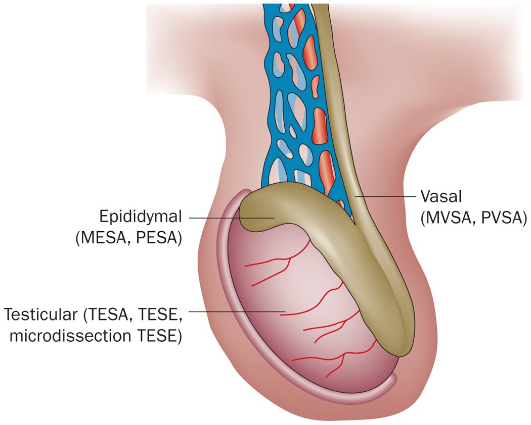 Eva or Vva for Male Infertility