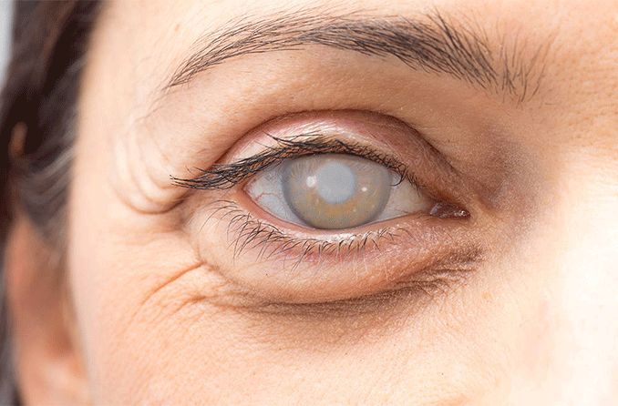 CATARACT Secondary IOL Implantation Single Eye