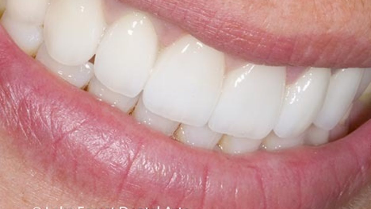 Full Mouth Implant