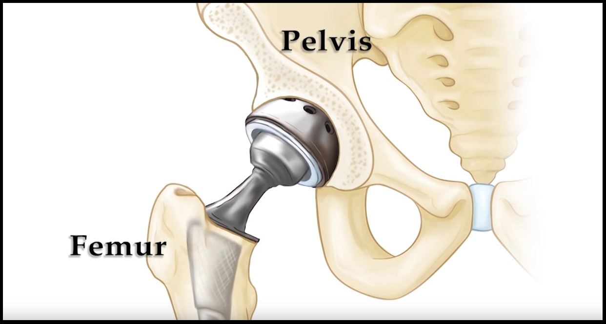 Total Hip Replacement UL