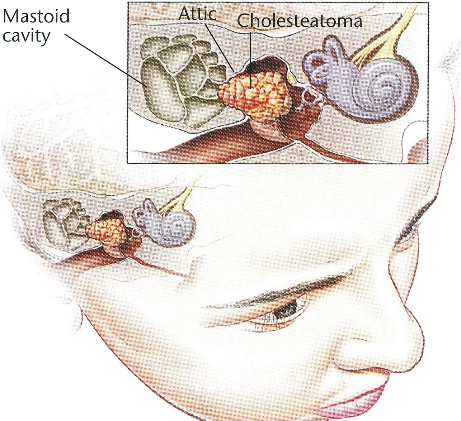 Mastoidectomy and Tympanoplasty Including Meatoplasty