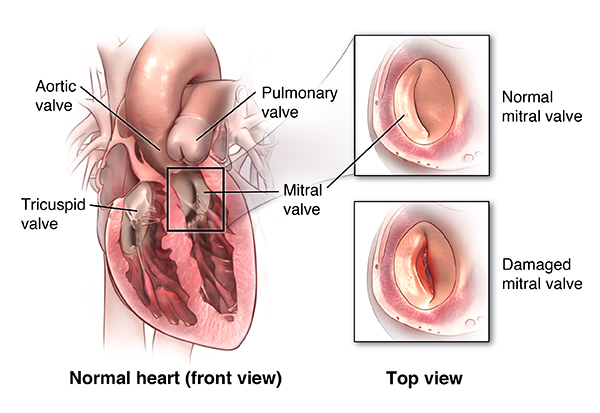 Mitral Valve Replacement