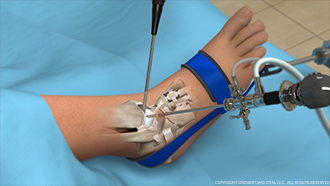 Ankle Arthroscopy
