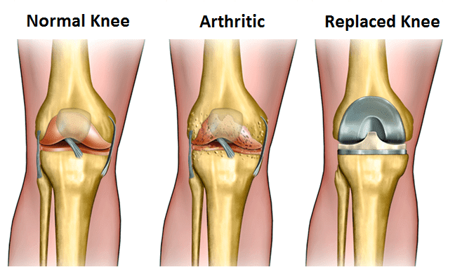 Total Knee Replacement BL