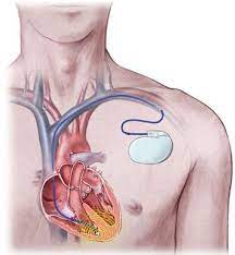 Three Cavity ICD