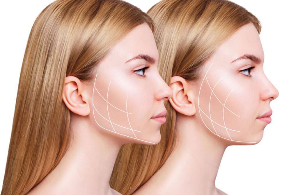 Buccal Fat Pad Removal