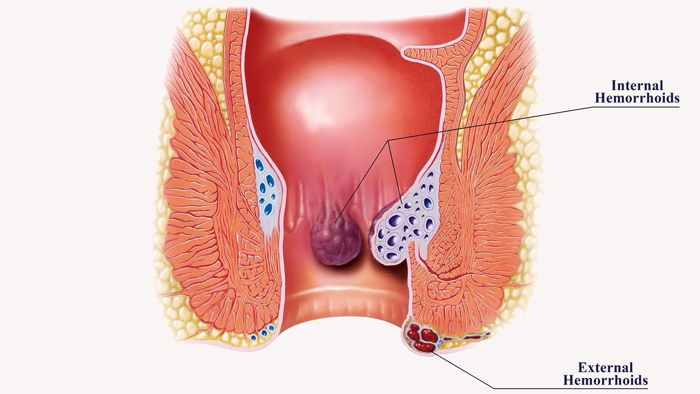 Haemorrhoids Treatment